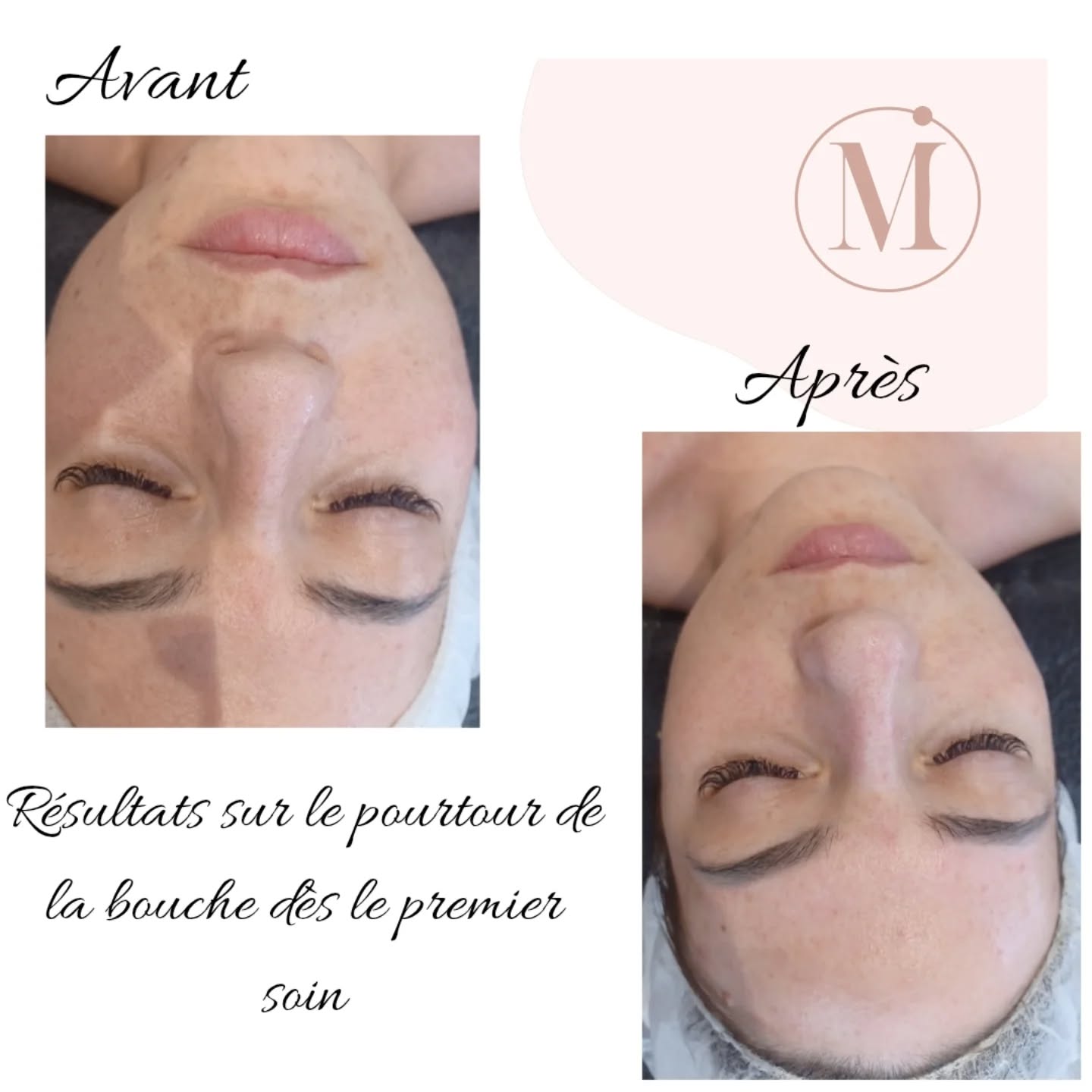 Résultat avant/après traitement esthétique - Éclat et fermeté de la peau