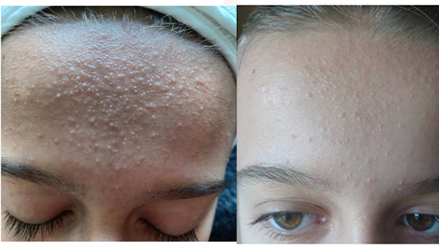 Soin spécial ado Acné - Traitement doux pour peaux adolescentes